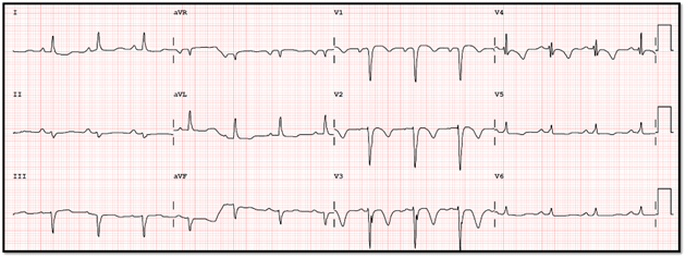 🆕 ¿Cómo son las ondas T negativas isquémicas?
💊💛#pildoraecg 

📌cardioteca.com/pildoras-ecg/5…

#cardiologia #cardiotwitter #ECG @HiguerasJavier