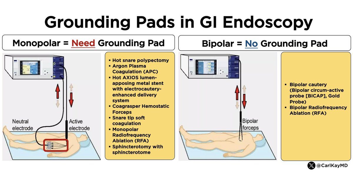 Grounding Pads in Endoscopy 🔴 Grounding pad v 🔵 no grounding pad? 🔑 Understand if you’re using monopolar or bipolar device (complete circuit) ▪️Hot snare ▪️APC ▪️Hot AXIOS w/ electrocautery system ▪️Coagraspers ▪️Snare tip soft coag ▪️Monopolar RFA ▪️Biliary sphincterotomy