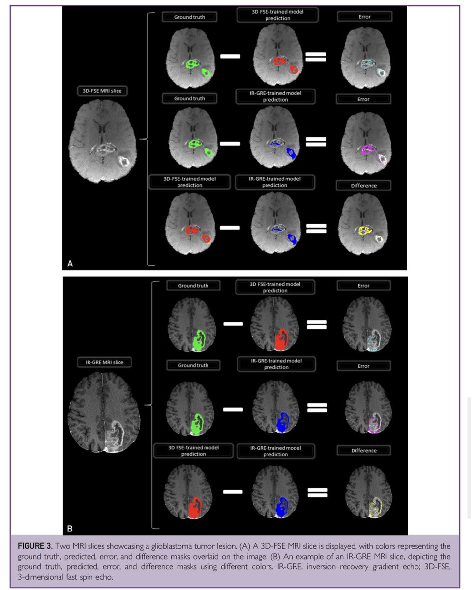 In our recent publication, we explored how adding heterogeneity in the training set helps #glioblastoma tumor #segmentation generalization! mcpdigitalhealth.org/article/S2949-… Thanks to @ShahriarFaghani and @giemmecci and special thanks to my amazing mentor @Slowvak!