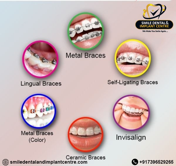Shine your brightest smile with the right braces! Discover the Best #Braces for Your #Smile. Book an appointment with #DrSudhakarMDS today at #SmileDentalandImplantCentre. 

For an Appointment Call +91-7396529265 
#braces #metalbraces #ceramicbraces #lingualbraces #clearaligners