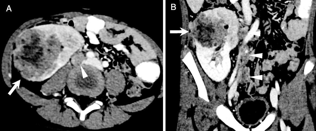 Current Issue: FDG PET/CT Findings of Malignant Rhabdoid Tumor Arising From a Renal Allograft dlvr.it/T5tzl9