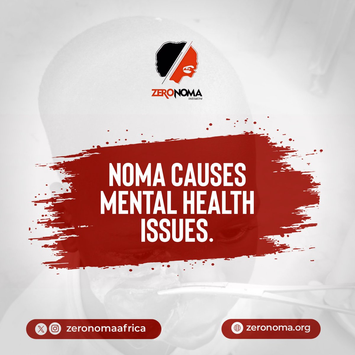 ZeronomaAfrica's tweet photo. Loss of tissue>>facial asymmetry>>disrupted functions and appearance >>stigma

#Zeronoma
#ZeroStigma https://t.co/J7gi5NDUD2