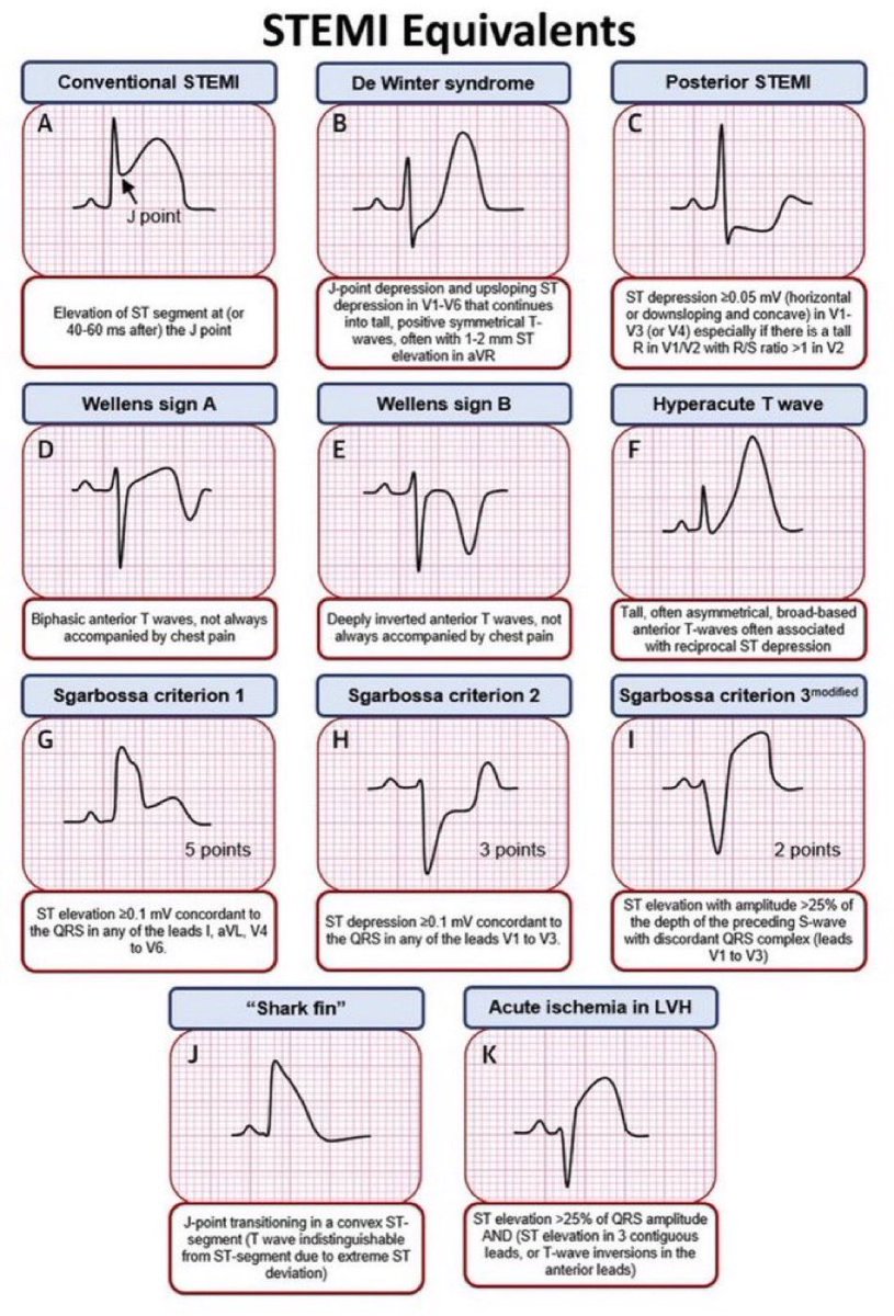 STEMI equivalents <a href="/patrickching/">Patrick Ching</a> #MedX