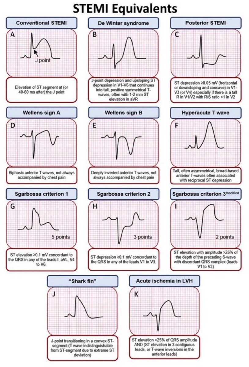 STEMI equivalents @patrickching #MedX