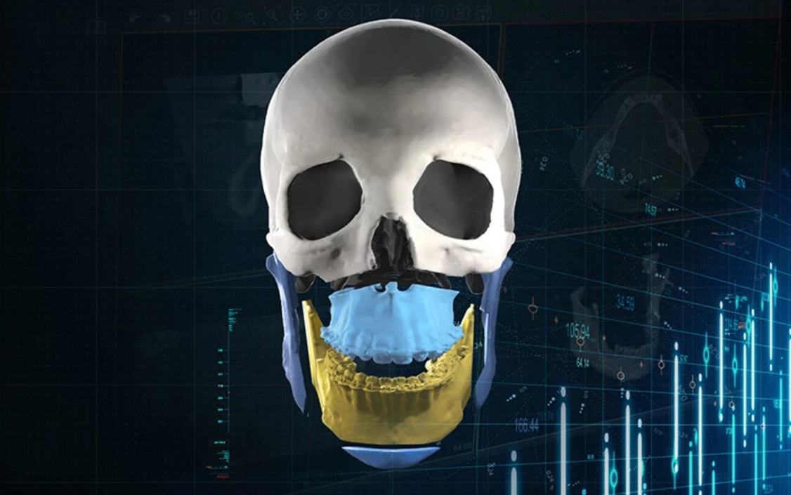 dailycadcam's tweet image. Materialise Releases Mimics Enlight CMF for Improved 3D Surgical Planning dailycadcam.com/materialise-re… @MaterialiseNV #surgicalapplications #automation #medical3dprinting #healthcare