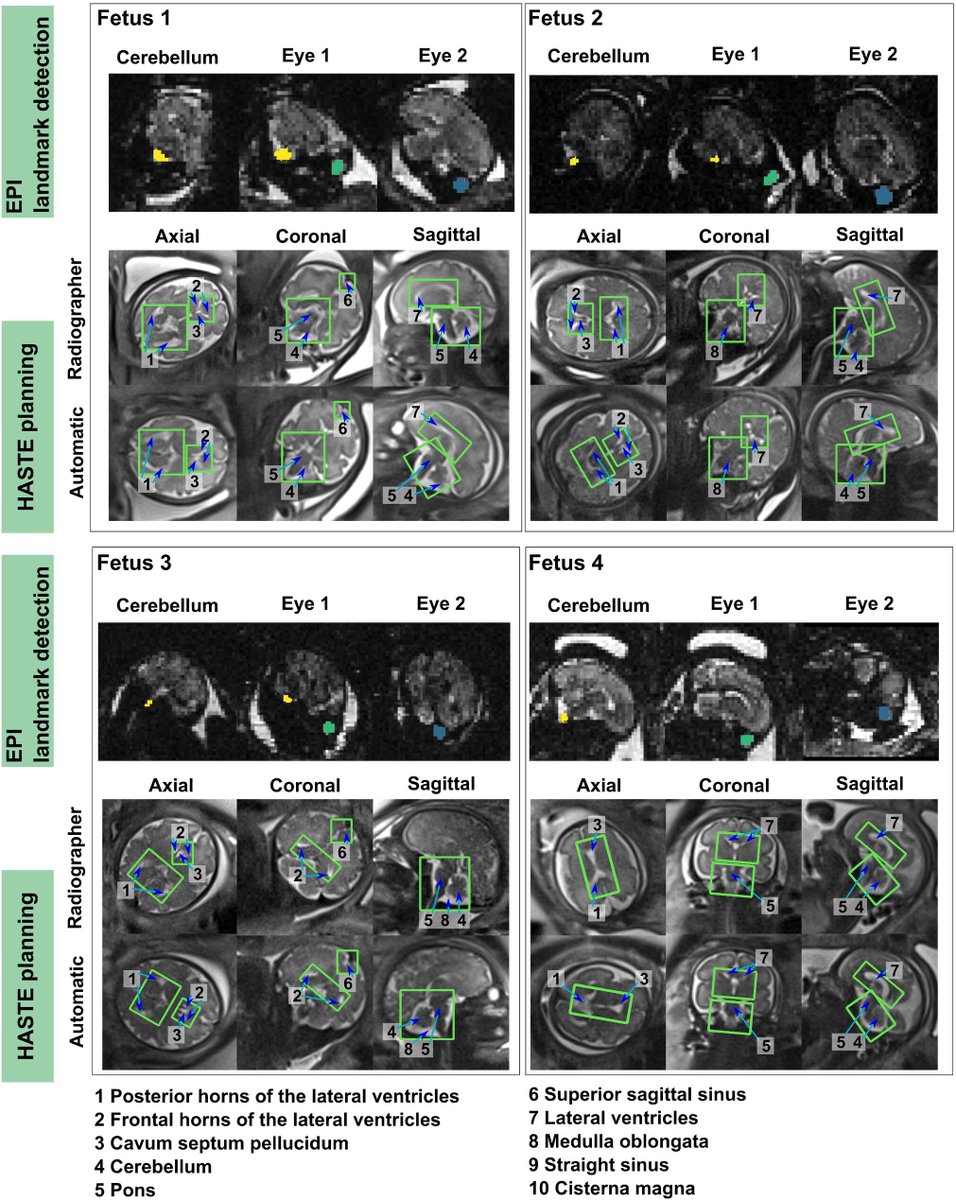 Our paper on fully automated planning of anatomical fetal brain MRI scans at 0.55T is now available! The purpose of this work is to widen the availability of fetal MRI beyond specialist centres. Grateful for the wonderful co-authors who made it happen! onlinelibrary.wiley.com/doi/10.1002/mr…