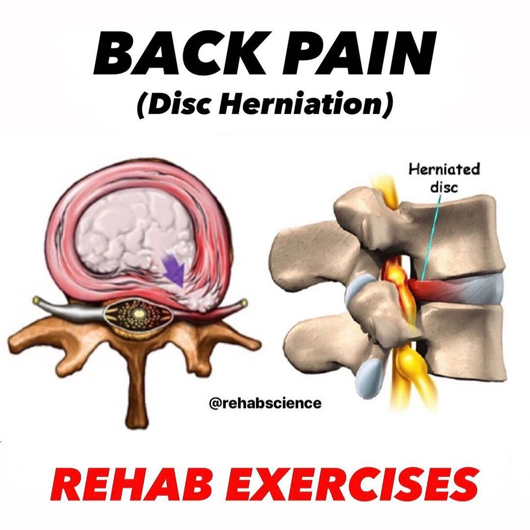 👇Rehab for Lower Back Pain👇 Credit🎥 IG: rehabscience 
• 
#sciaticapain #discpain #physicaltherapist #physicaltherapy #physiotherapy #physiotherapist