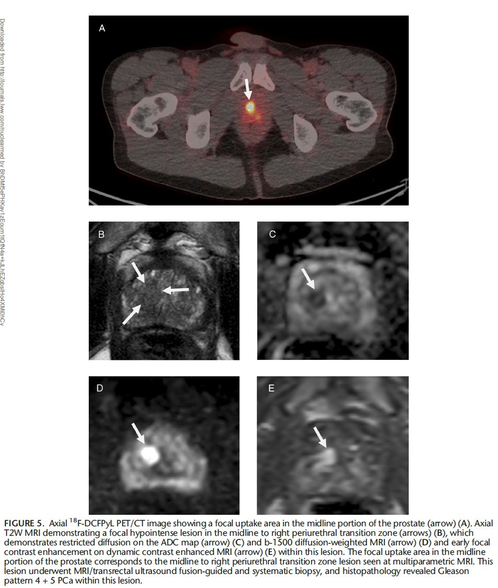 📣I am happy to share our new article 'Reducing False-Positives Due to Urinary Stagnation in the Prostatic Urethra on 18F-DCFPyL PSMA PET/CT With MRI' journals.lww.com/nuclearmed/ful… 👍Congratulations to @davidgelikman and our Team #prostatecancer #CancerResearch #TeamScience…