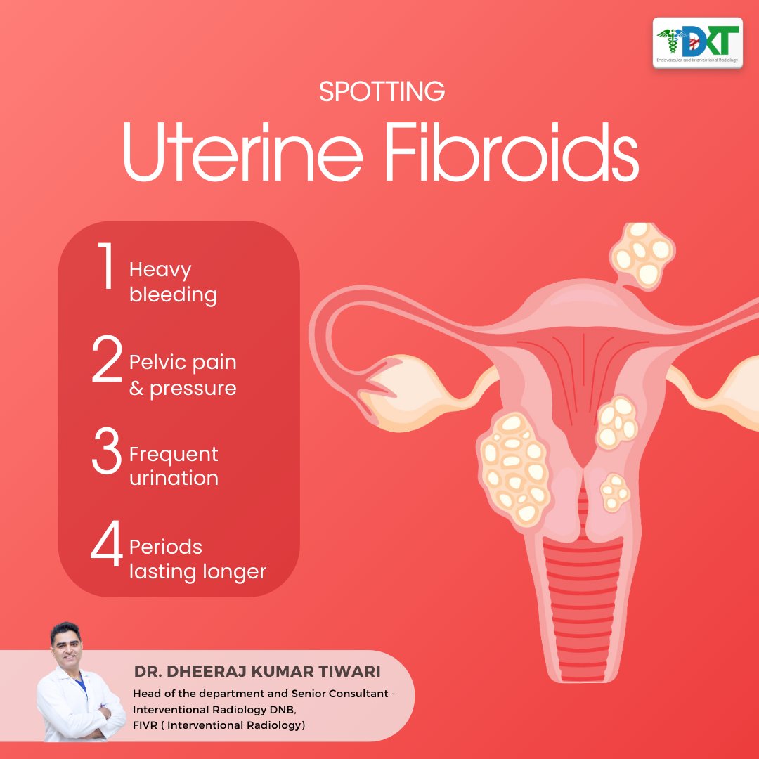 Understanding Uterine Fibroids: Expert Insights for Effective Management
.
.
.
#DrDheerajTiwari #vascularsurgery #vascular #veinspecialist #vascularsurgeon #endovascularsurgery #FibroidFighters #HolisticHealing #WellnessJourney #uterinefibroid #uterinearteryembolization