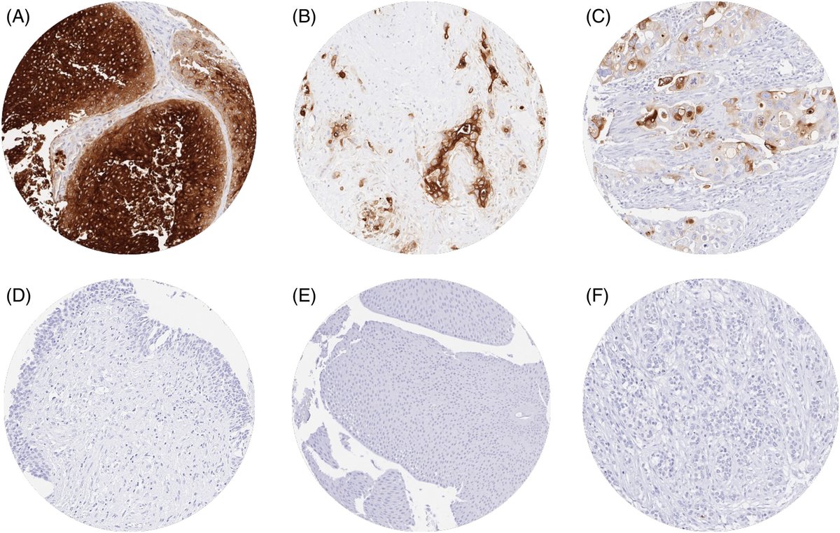 CEA (CEACAM5) expression is common in muscle-invasive urothelial carcinoma of the bladder but unrelated to the disease course
#BladderCancer @HenningPlage et al

doi.org/10.1002/bco2.3…