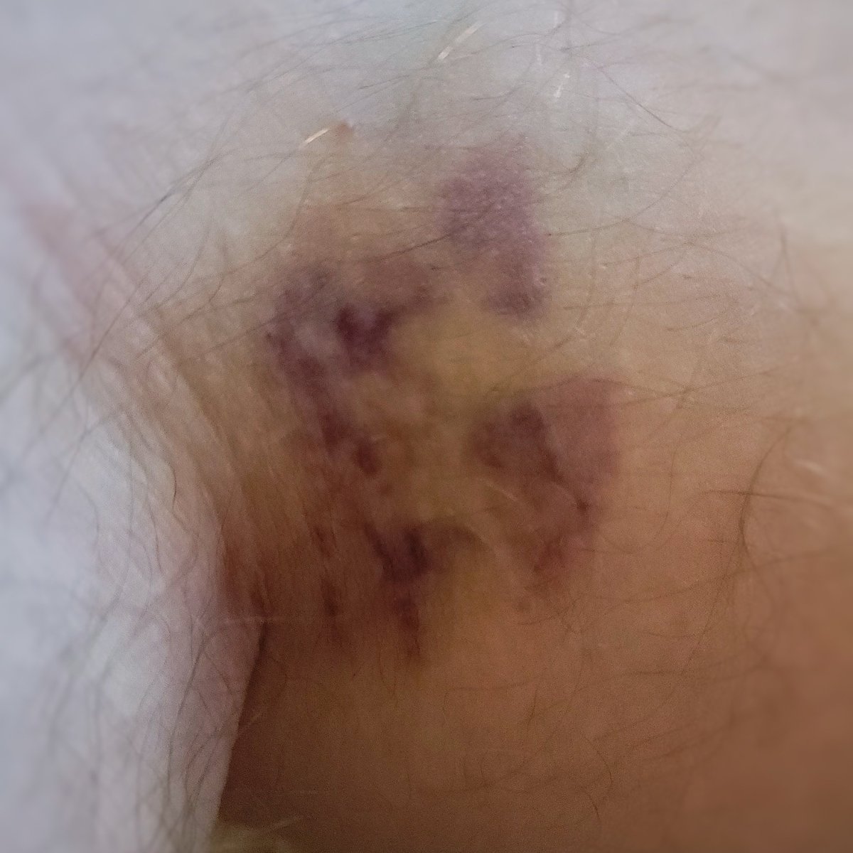 Damnit. I guess I was sitting weirdly with pressure under my knee while gathering and reading through COVID studies overnight. Shit. Anyone else bruise from bad or strange posture? 😔
