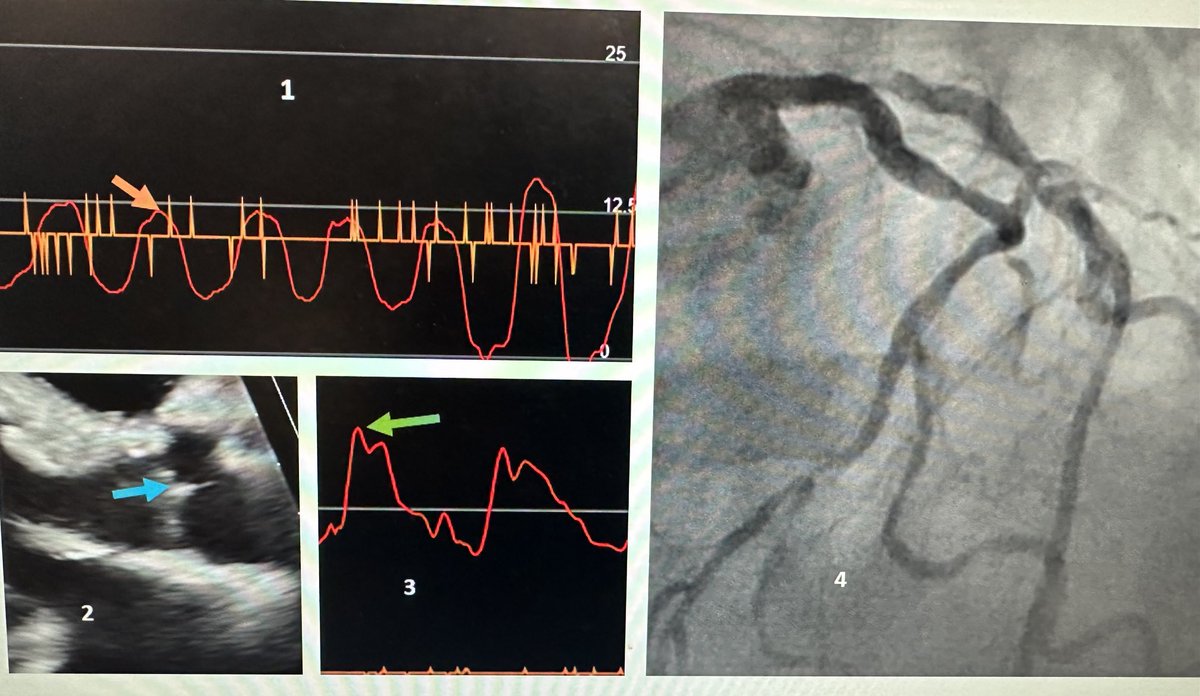 Answers to yesterday’s trivia 1. Giant “V” waves in TR. look at pressure data. 2. Papillary fibroelastoma at AV in a young lady causing multiple strokes. 3. Spike & dome in obstructive HCM. 4. Multivessel dx in a diabetic patient with severe LV dysfunction.