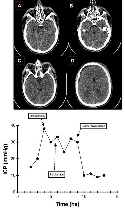 Grille et al: Intracranial Hypertension with Patent Basal Cisterns: Controlled Lumbar Drainage as a Therapeutic Option. Selected Case Series Link: link.springer.com/article/10.100… @neurocritical #NeuroCritCare