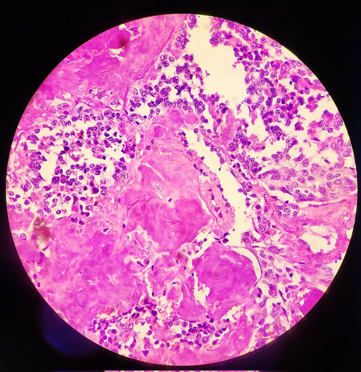 #Histopathology 
#metastasis
#lymph node
#photomicrograph
#PathTwitter 
50-yr. M
Specimen : Cervical lymph node ( biopsy).
Dx: Compatible with metastatic medullary thyroid carcinoma. 
Immuno recommended.