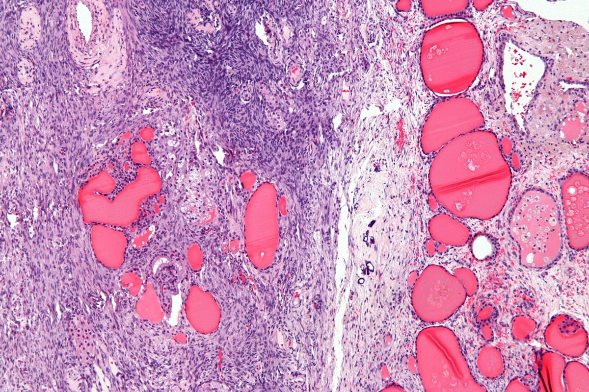 Hyperthyroidism in young female with normal thyroid and pituitary glands ??
Think about struma ovarii ...
Struma ovarii: monodermal teratoma with thyroid tissue, it may present with hyperthyroidism. 
#medtwitter