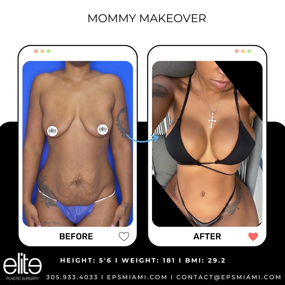 This Elite Queen had a #mommymakeover by ​Dr. Salama. She is looking snatched!
​​​💻​ epsmiami.com
​​​📞​ 305.933.4033
​​​📧​ contact@epsmiami.com
​​#abdominoplasty #abdominoplastia #breastaugmentation #tummytuck #plasticsurgery