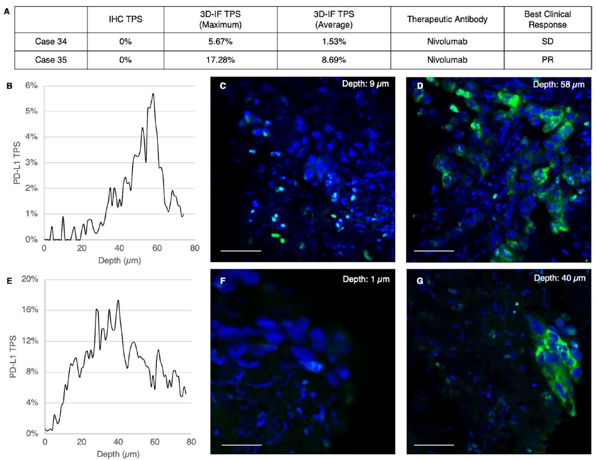 alpenglowbio's tweet photo. Happy #LearningWednesday! Let's delve into how advanced non-destructive 3D imaging technologies reveal tumor heterogeneity and assess PD-L1 expression in non-small cell lung cancer, uncovering depth-level variations missed in traditional imaging methods. https://t.co/NLn50Qga4v https://t.co/OFfpbI4nDu