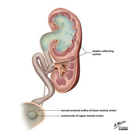 SocUroPedMx's tweet photo. Respuesta Correcta: 𝔽𝔸𝕃𝕊𝕆

✅El uréter del polo superior suele tener una inserción ectópica, inferior y medial al ureter del polo inferior.

📌Así, un uréter ectópico suele estar propenso a la 👉🏽OBSTRUCCIÓN

«El inferior (polo renal) refluye, el superior (polo) se obstruye» https://t.co/CwCEJNZmbv