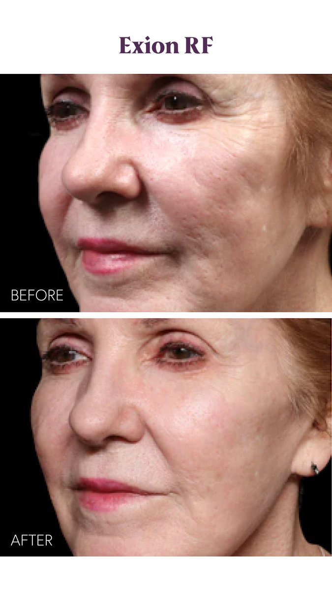 Beautiful #ExionRF results this #TransformationTuesday🤩

Exion combines microneedling with radiofrequency and AI ultrasound technology to address a variety of skin concerns.