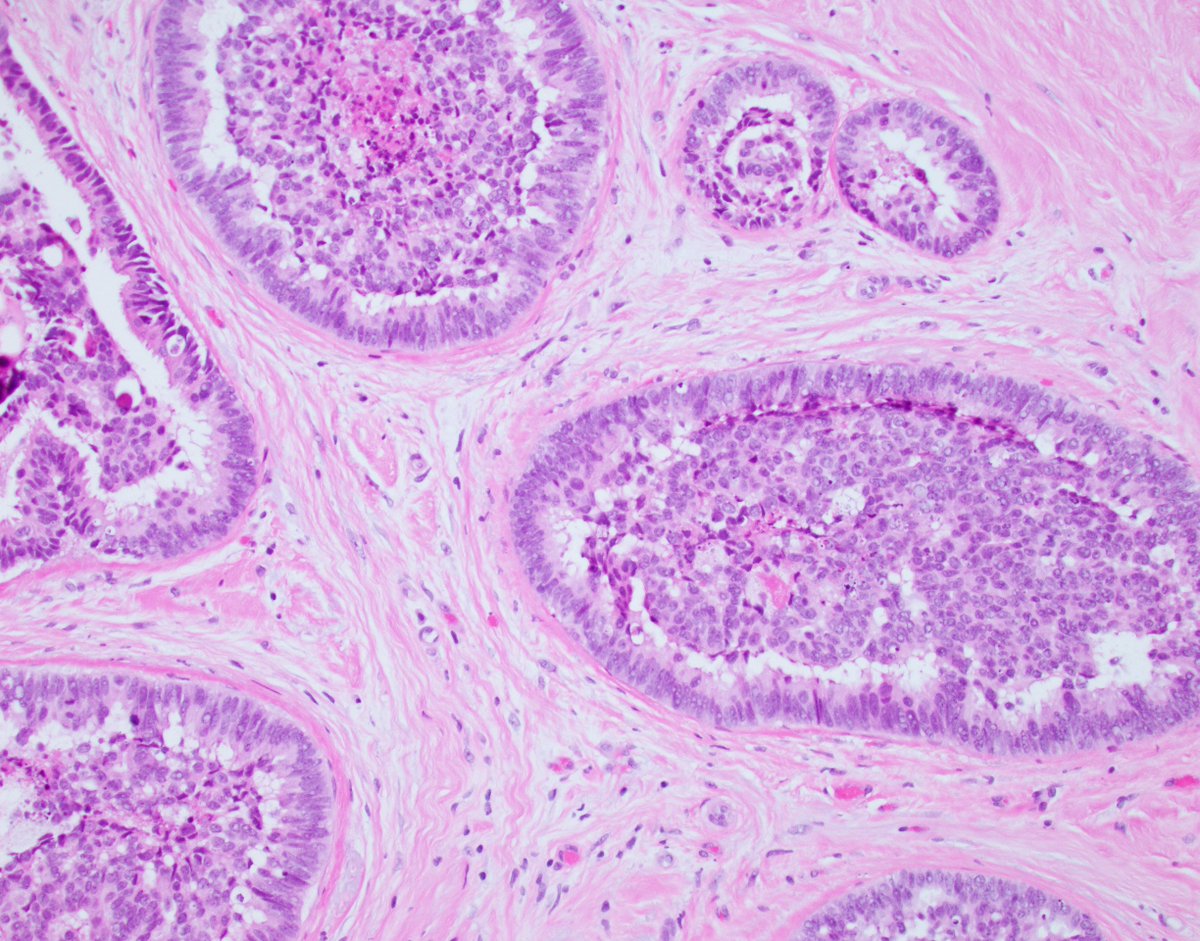 Peripheral slit-like spaces and a glomeruloid architecture are indicative of usual ductal hyperplasia, until they're not. Here's some glomeruloid intermediate-grade ductal carcinoma in situ for your eyes to feast on. #PathTwitter #breastpath @wusm_pathology @washupathedu