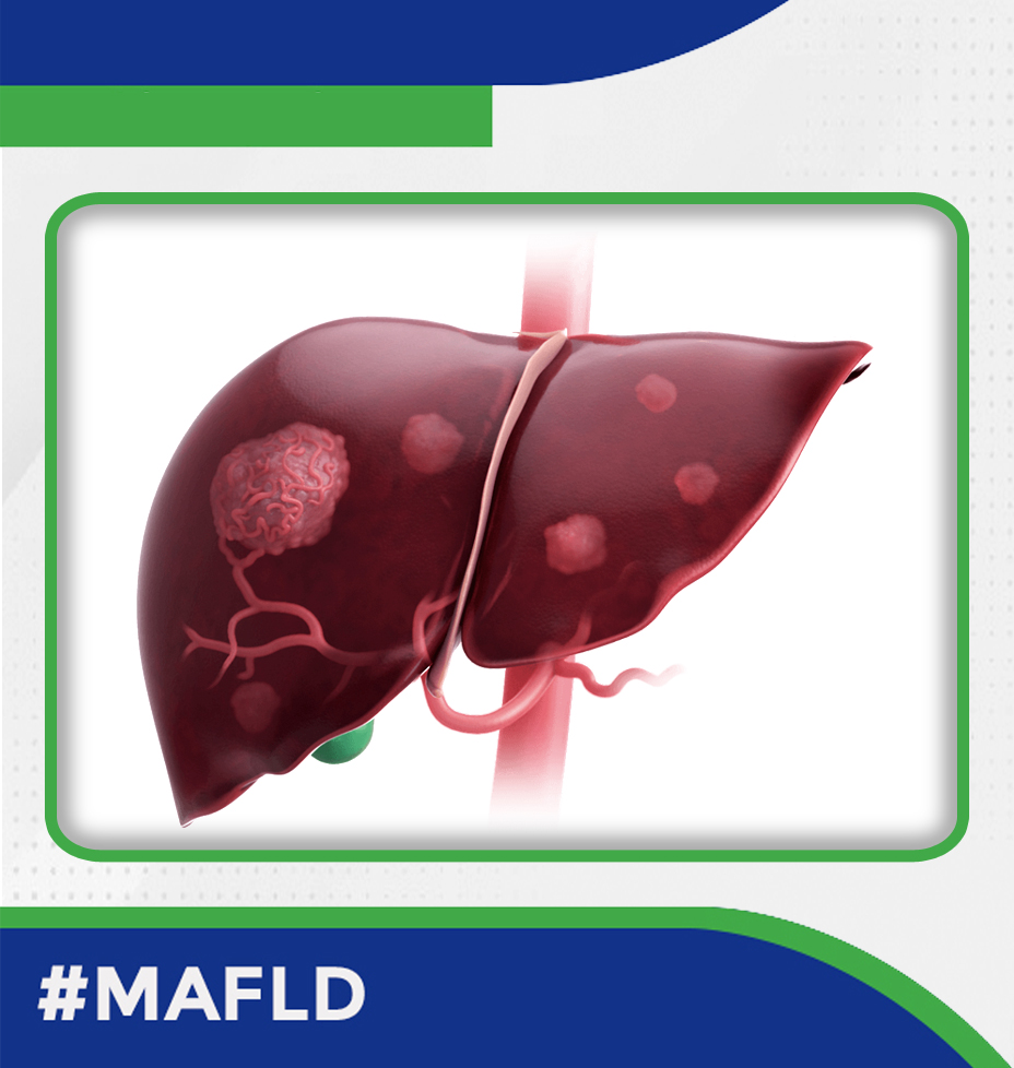 🚨🚨 #MAFLD 
MAFLD-related hepatocellular carcinoma

🆕 meta-analysis; 56,565 individuals with HCC.

📌Total MAFLD HCC prevalence : 48.7%
📌Single  MAFLD HCC prevalence: 12.4%.

➡️ MAFLD is common as a sole aetiology, but more so and as a co-factor in mixed-aetiology HCC