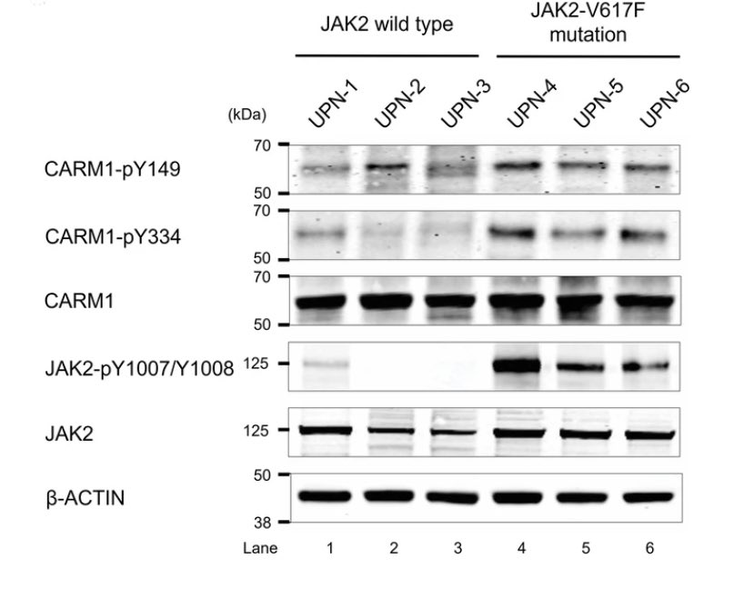Short summary, CARM1 is phosphorylated by JAK2 in myeloid cells when JAK2 itself is phosphorylated, like in the case of JAK2 V616F mutant #MPNsm patients