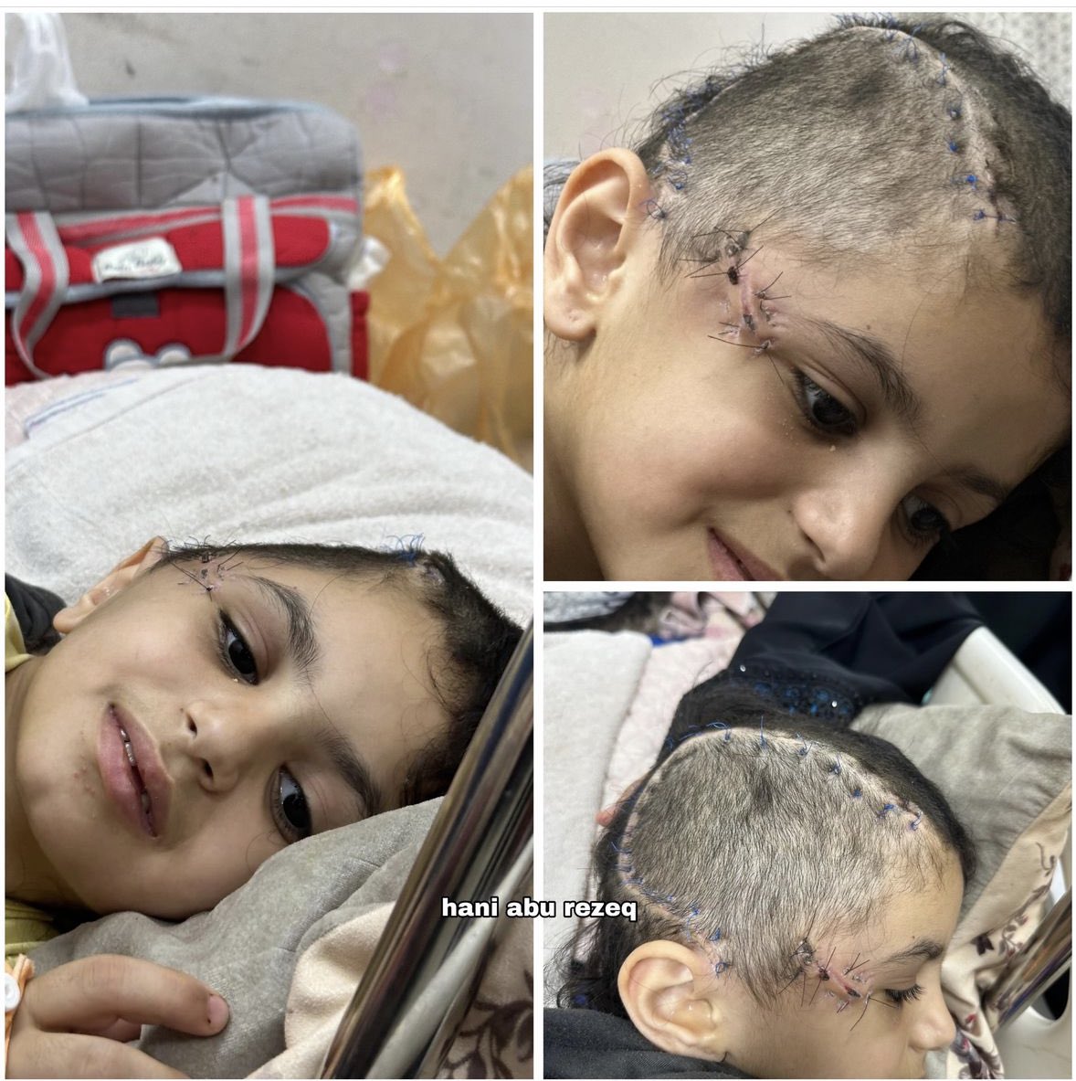 Meet Maya, 9 years old. Her head was left disfigured after a large part of her skull was lost due to an Israeli army airstrike on her family's home! This is the Israeli army's targets and these are the Crimes that history will never forget, and all of you are witnesses to them!