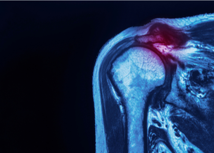 Don't let #shoulderpain hold you back. Dr. Getelman offers personalized treatment plans for shoulder labral tears and SLAP tears, tailored to your needs. Discover your options: medilink.us/jc6x  #ShoulderRelief #Arthroscopy