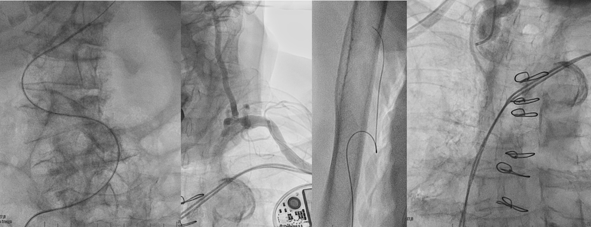 Sometimes...it is just impossible!
82 yr-old after CABG in 2002. At least we can state, LIMA is occluded. 

#tripleaccess #invain #radialfirst #femoralfirsthere
