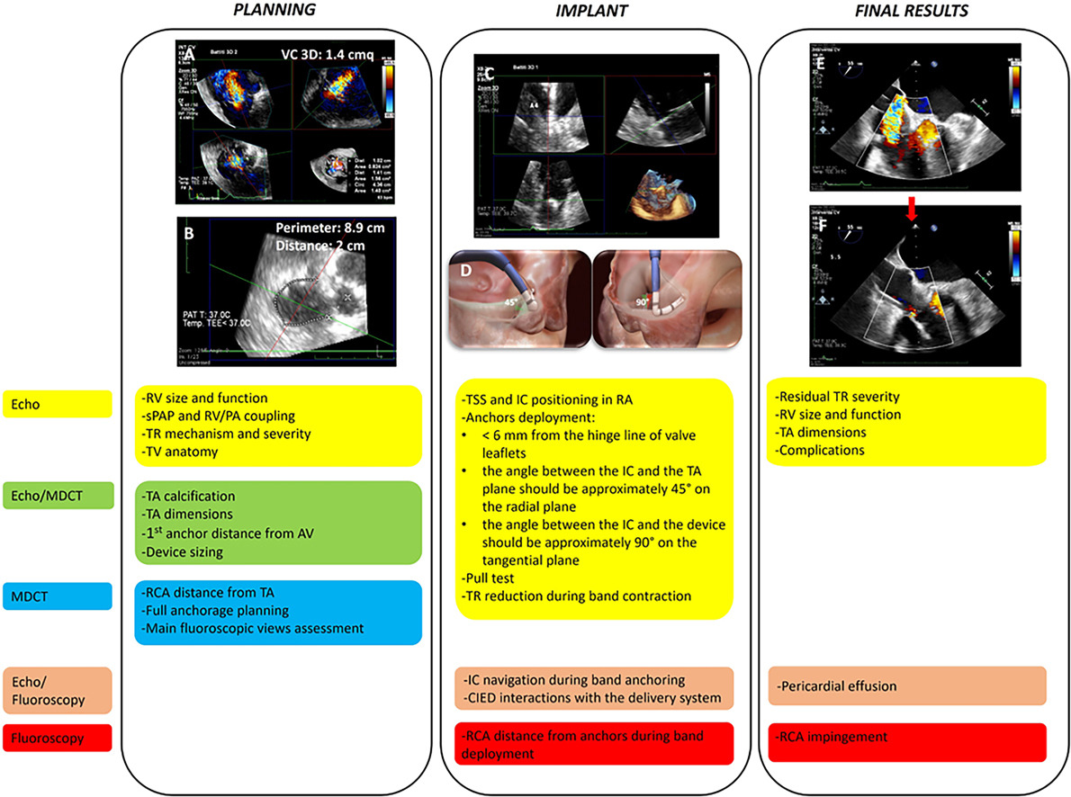 We discuss the current role of multimodality imaging in planning direct transcatheter tricuspid valve annuloplasty and describe all procedural steps focusing on echocardiographic monitoring. Read our @JournalASEcho article: bit.ly/3Ud53hH