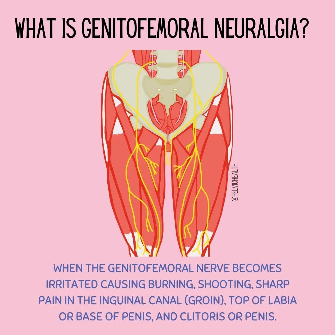 If you haven’t heard of Genitofemoral Neuralgia, then STOP🛑 and swipe➡️ through. Genitofemoral Neuralgia can be confused with pudendal neuralgia because both nerves can cause pain in the clitoris and penis!
