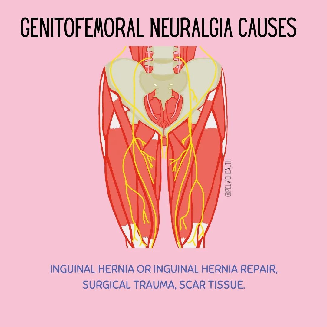 The primary difference between genitofemoral neuralgia and pudendal neuralgia is that genitofemoral neuralgia is ⚠️going to cause pain⚠️ in the inguinal canal (groin) whereas pudendal neuralgia will not.

#pudendalneuralgia #pelvicpain #pelvichealth #neuraglia #physicaltherapy