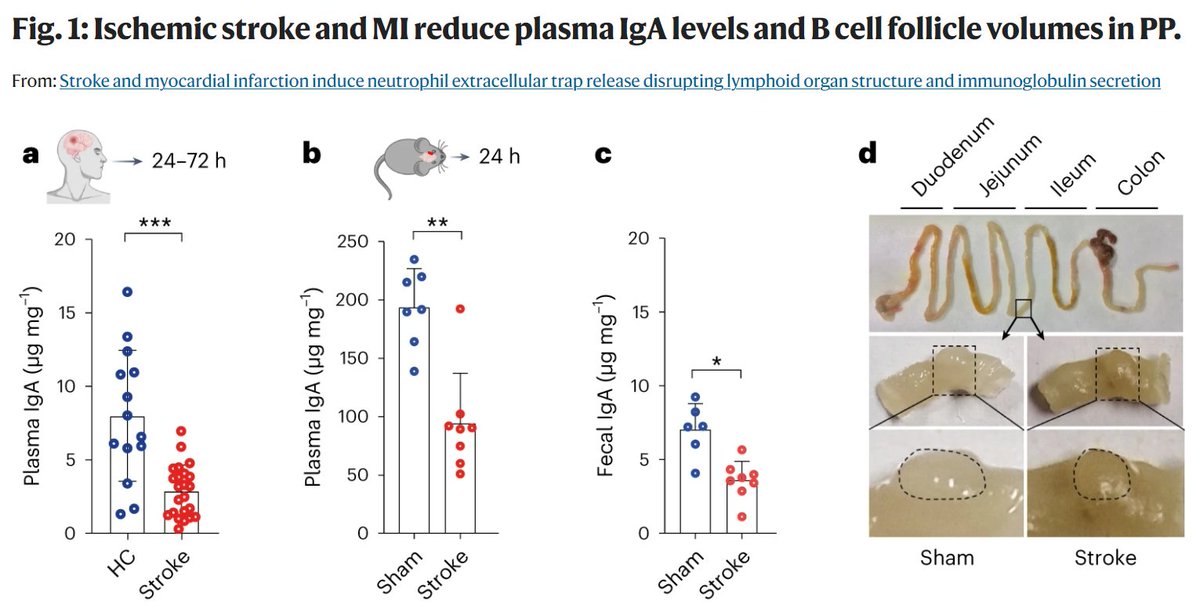 Research|Tuz et al report that #stroke and #MyocardialInfarction induce the release of neutrophil extracellular traps (NETs), loss of B cells and reduced IgA secretion, and that inhibition of NETs prevents loss of IgA in patients and mice. @GunzerLab
👉rdcu.be/dFxfR