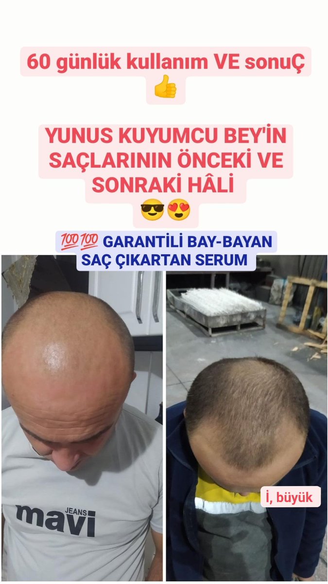 HAYIRLI SABAHLAR 🤲 💯💯 GARANTİLİ SAÇ ÇIKARTAN SERUM 😎 👉 MUTLAKA DENEYİN ✅SAÇI DÖKÜLMESİNE SON ❌ ✅ SAÇLARINIZ YENİDEN ÇIKSIN 👍 👉 DÜNYANIN HER YERİNE KARGO🌍 👇SPARİŞ İÇİN 👇 ☎️05525560155☎️ #SALI #BeşiktaşınMaçıVar