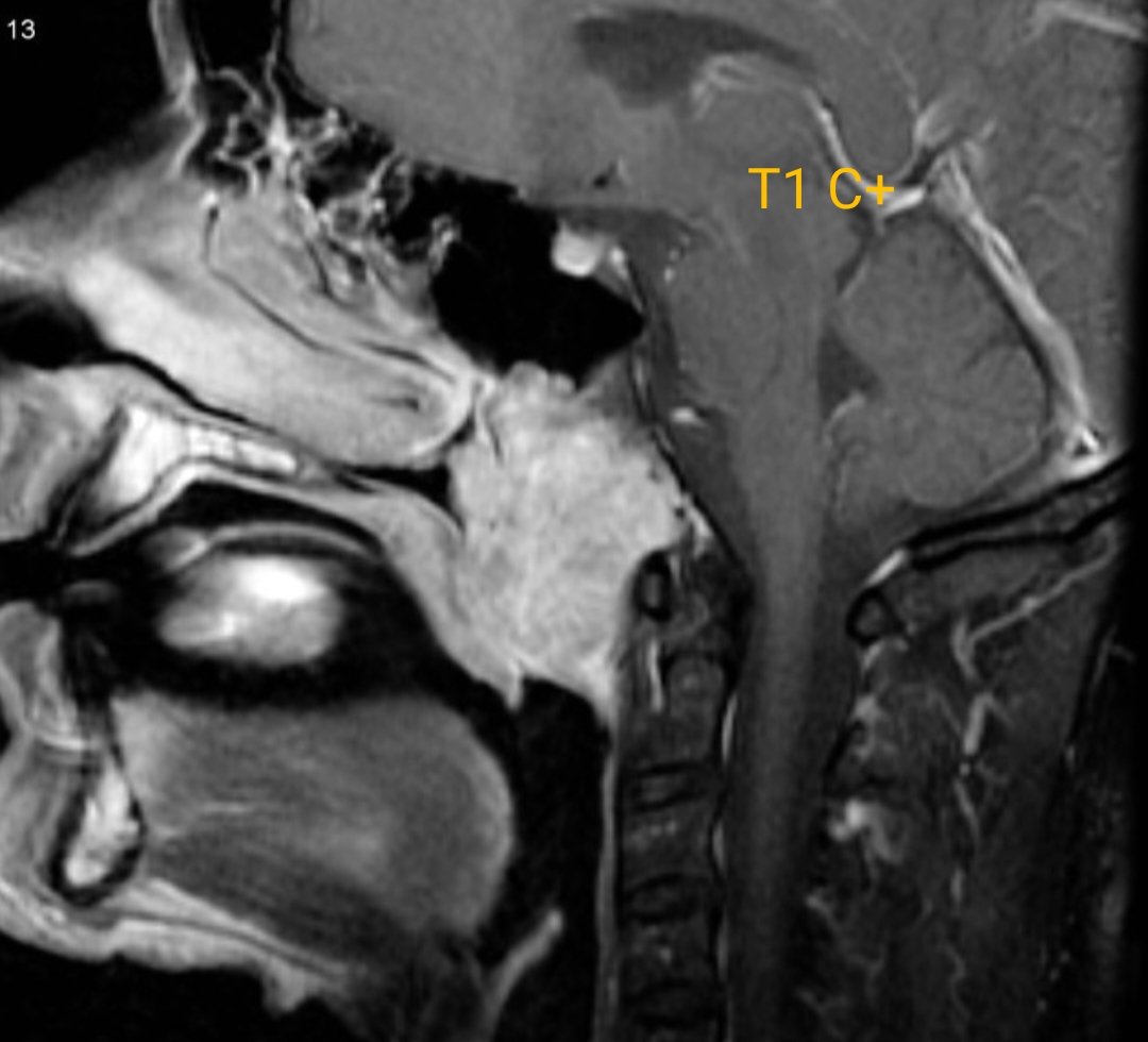 What is your dx or ddx??

#Radiology 
#Neurology #mri #neuroradiology 
#MedTwitter #MedEd #med #MedX