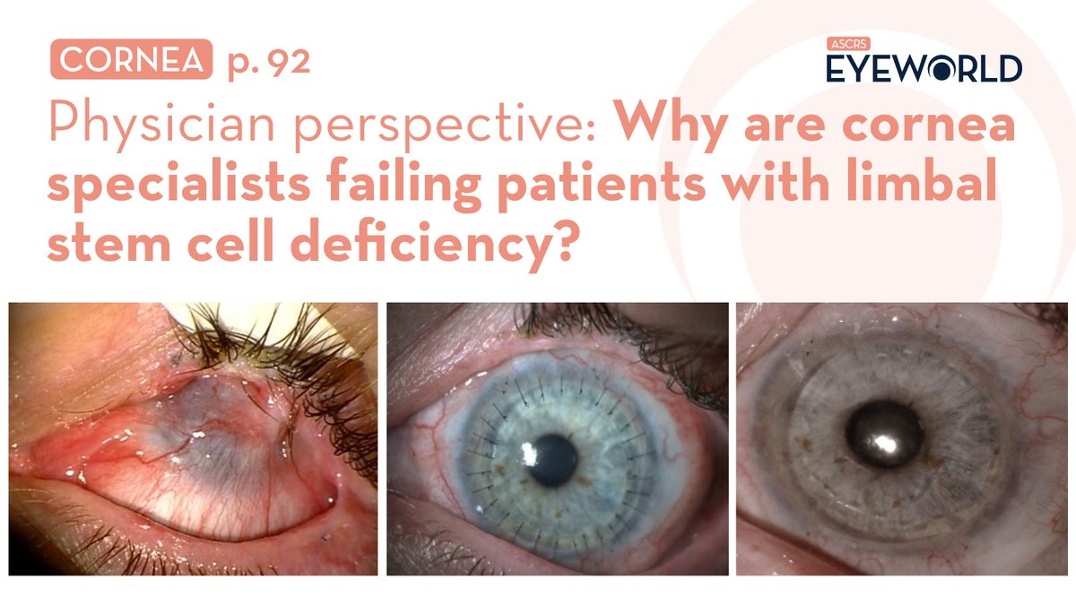 Edward Holland, MD, and Albert Cheung, MD, author the op-ed “Why are cornea specialists failing patients with limbal stem cell deficiency?” bit.ly/441VFSD #EyeWorldmagazine