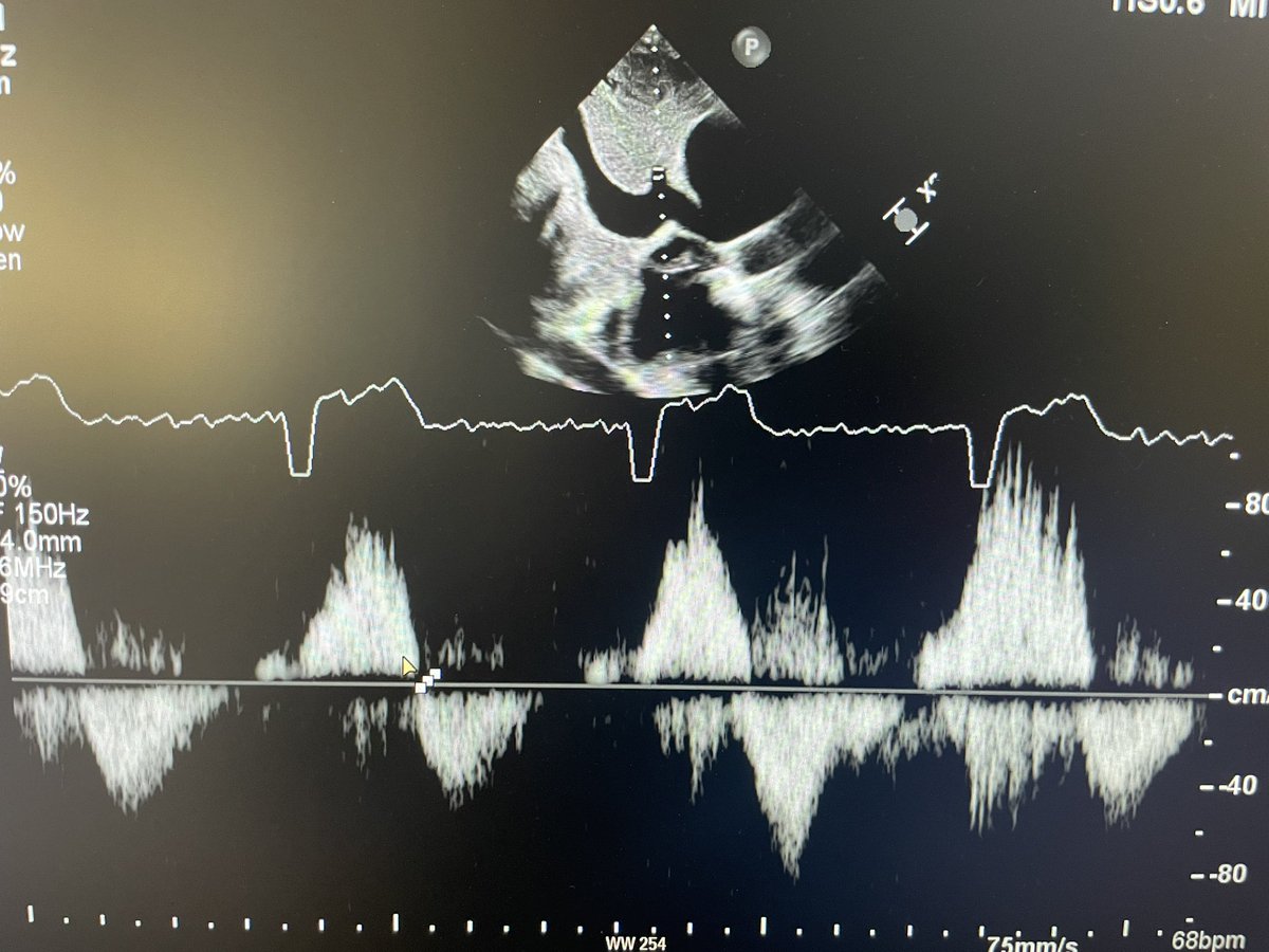 Systolic flow reversal over hepatic vein in severe TR #echofirst #echocases