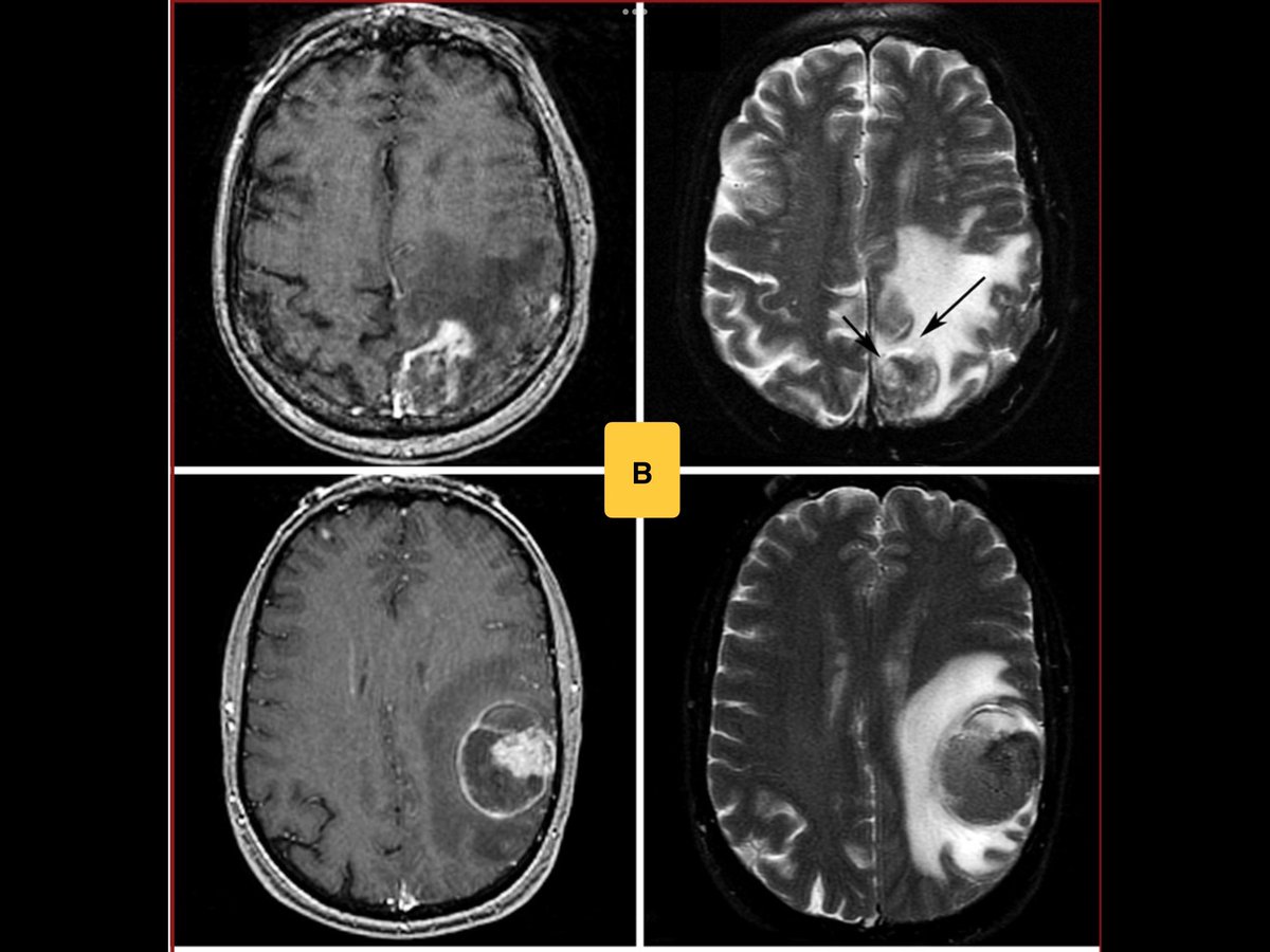 Which of the following is correct regarding post-Stereotactic Radiosurgery for brain tumors ⁉️

1-Group A represents post-radiation tumor re-growth 
2-Group B represents post-radiation necrosis 
3-Group A represents post-radiation necrosis
4-I don’t know