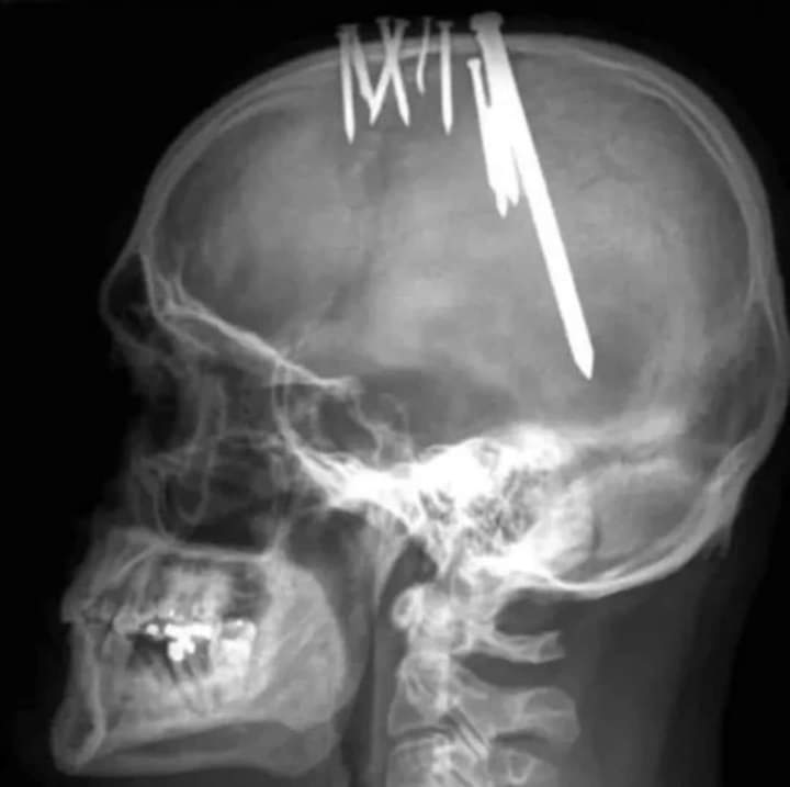 Radiografía cráneo de un paciente psiquiátrico que se autolesionó con una pistola de clavos, el clavo más grande le provocó hemiparesia (parálisis parcial en un lado del cuerpo).
Via: orgasmo visual 
Síguenos en Energy Conect ⚡