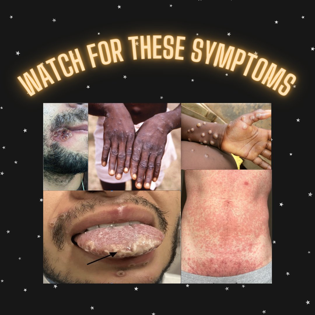 CCHEVillage's tweet photo. Don't let MPOX (Monkeypox) eclipse your summer plans! Think you may have these symptoms? See a doctor immediately so they can help.

Want to learn more about MPOX or interested in learning how to prevent an MPOX infection? Give us a call or stop by the Village, we can help! https://t.co/RkEFFkQCXw