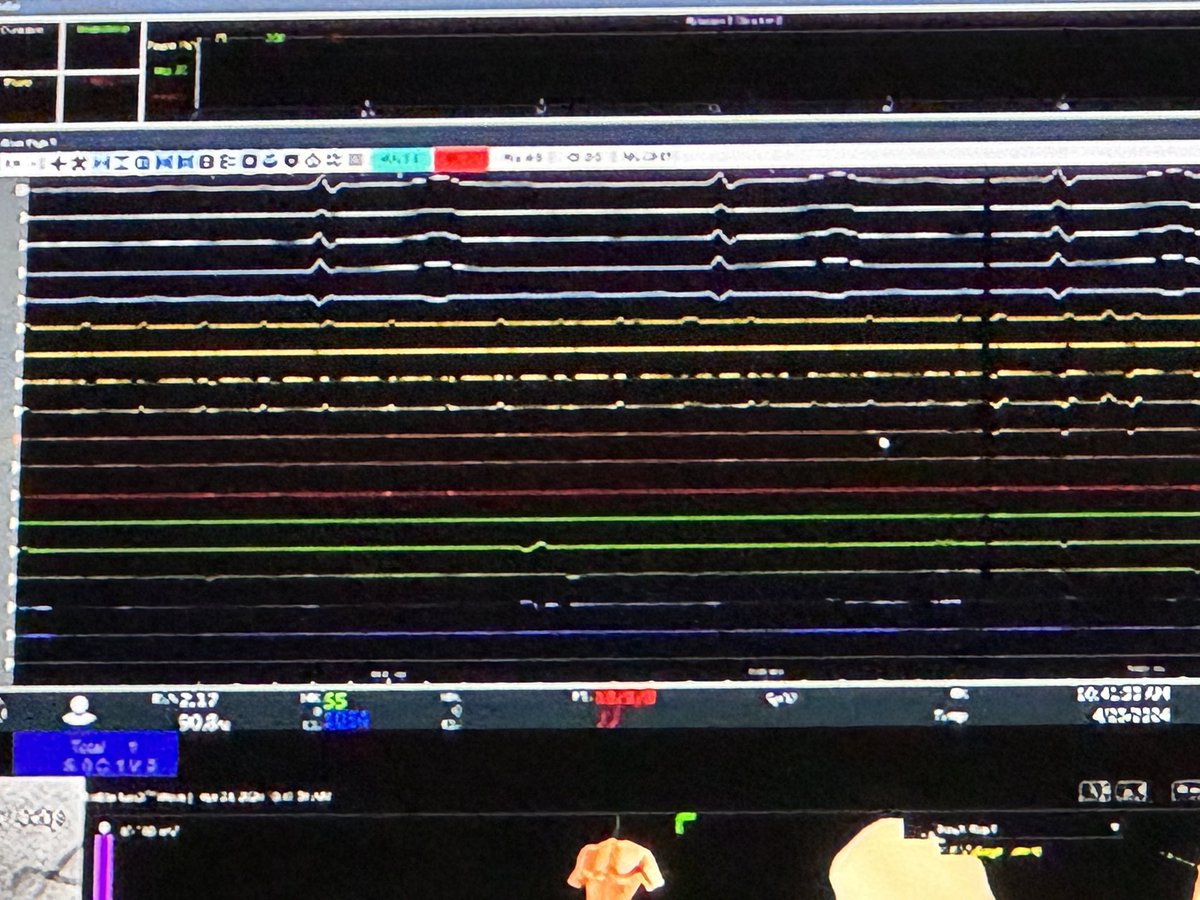 Live case on alcohol ablation via the vein of Marshall for atrial fibrillation ⚡️. Now that’s a whole new level of EP & IC skills put together. Congratulations on the great result. Very elegant team work @SrihariNaiduMD @seiiwaiEPmd & @BeaumontHealth team. @MLabedi