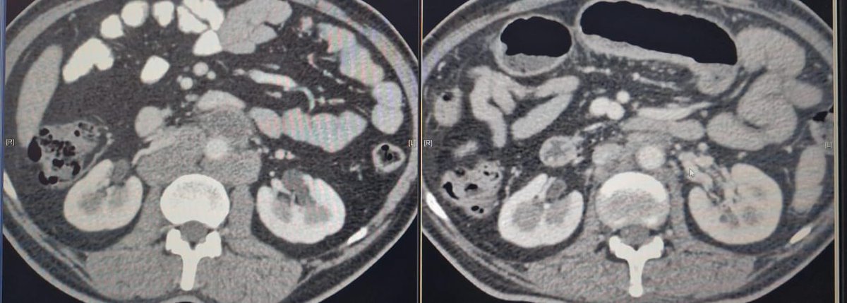 TCa Day 23 BEP for advanced seminoma works like a charm... Mostly. Occasionally CVS toxicity rears it's ugly head. 50y had acute MI post 1# BEP. Mass down from 8 cm to 3cm. Rest polished off by 36Gy. NED 3y on. We have a small series now. 😊 Anyone else faced this?