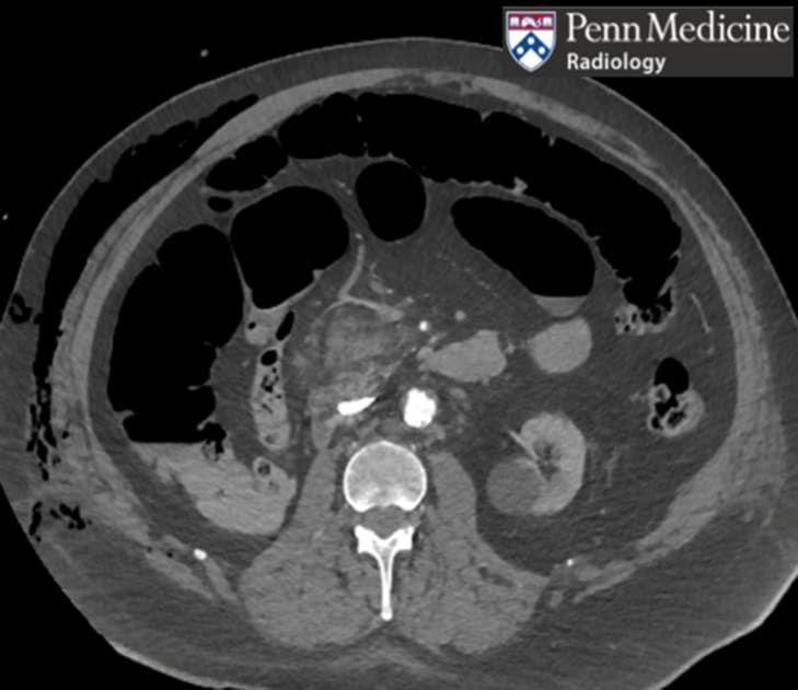 70-year-old man with abdominal pain #radiology @PennMedicine buff.ly/4d991k8