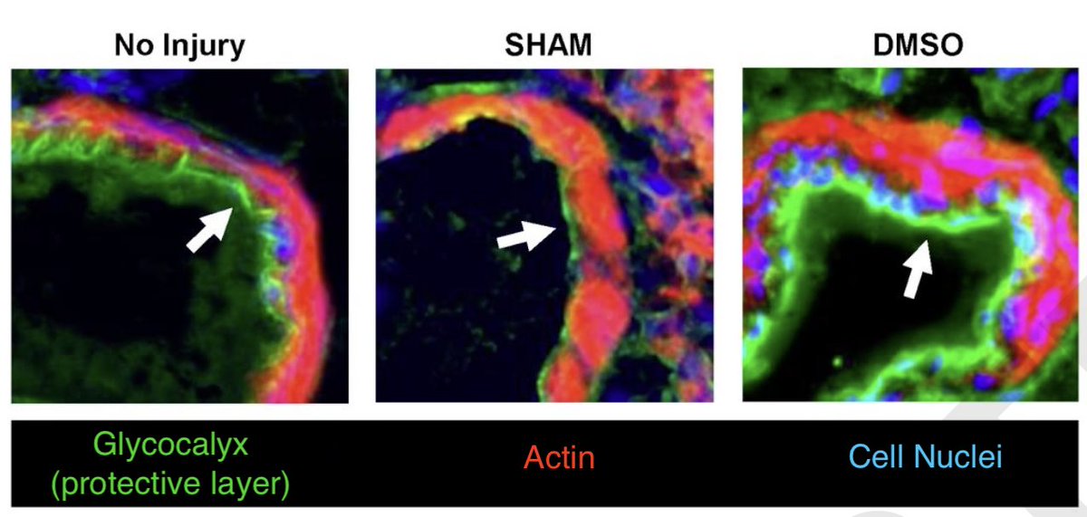 A study under Tulane's Dr. Jackson-Weaver discover dimethylsulfoxide shows promise in treating acute respiratory distress syndrome by reducing lung inflammation and protecting vascular barriers potentially preventing lung damage.  #TulaneResearch #LungHealth #Medicine