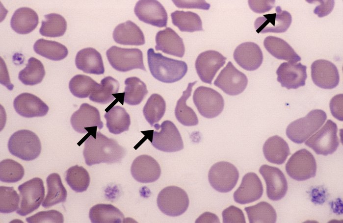 Heinz bodies are seen in?
A) Splenectomy
B) G6PD deficiency 
C) Rheumatic fever 
D) Spherocytosis 
@IhabFathiSulima @fxgodzeuss #MedTwitter #MedEd