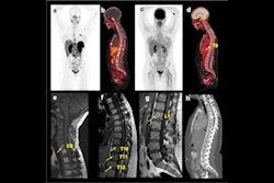 PET/CT superior to MRI for detecting spinal bone metastases #radiology #MRi @NIH buff.ly/4aPxjhE