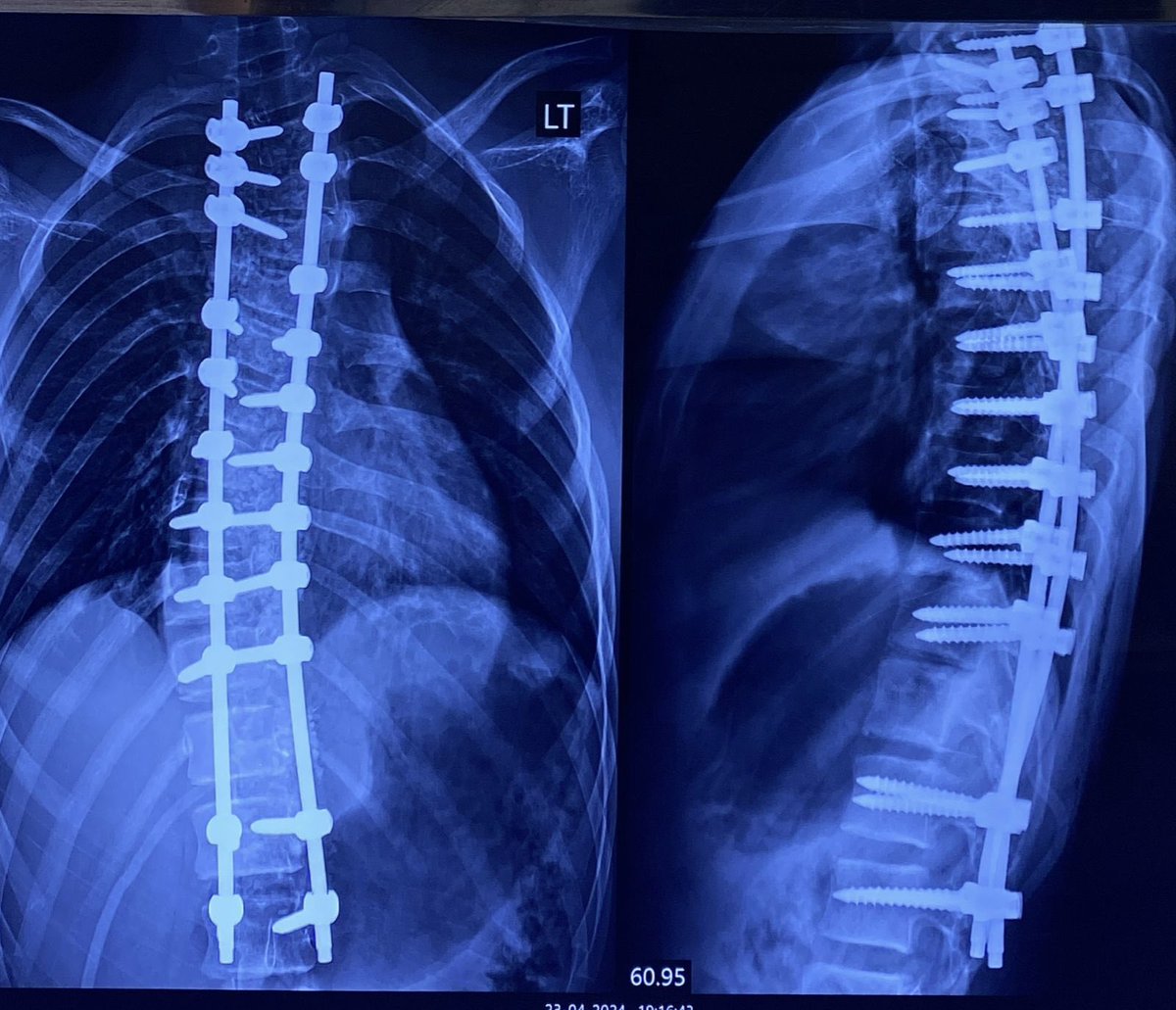 Segmental spinal instrumentation (SSI) from D2 to L2 in 16 years old boy having adolescent idiopathic scoliosis (AIS) Lenke 2CN curve. @scolionetwork  #OrthoTwitter #MedTwitter #spine