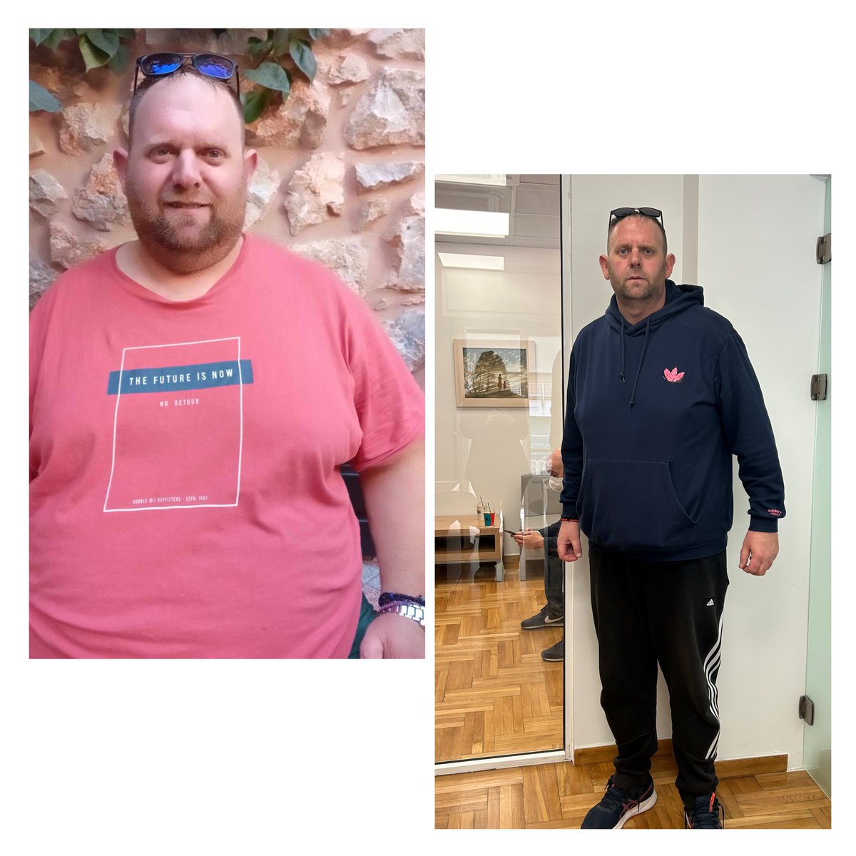 🔹Εντυπωσιακά αποτελεσματα μετά το ειδικό γαστρικό μανίκι από τον ιατρό Σωτήρη Γαβριήλ. 

Ο φίλος μας κατάφερε να χάσει 73 ολόκληρα κιλά σε μόλις 5 μήνες. Έχει καταπολεμήσει την κεντρική παχυσαρκίας κι έχει αλλάξει ριζικά η ζωή.

 #γαστρικο_μανικι #sleevegastrectomy