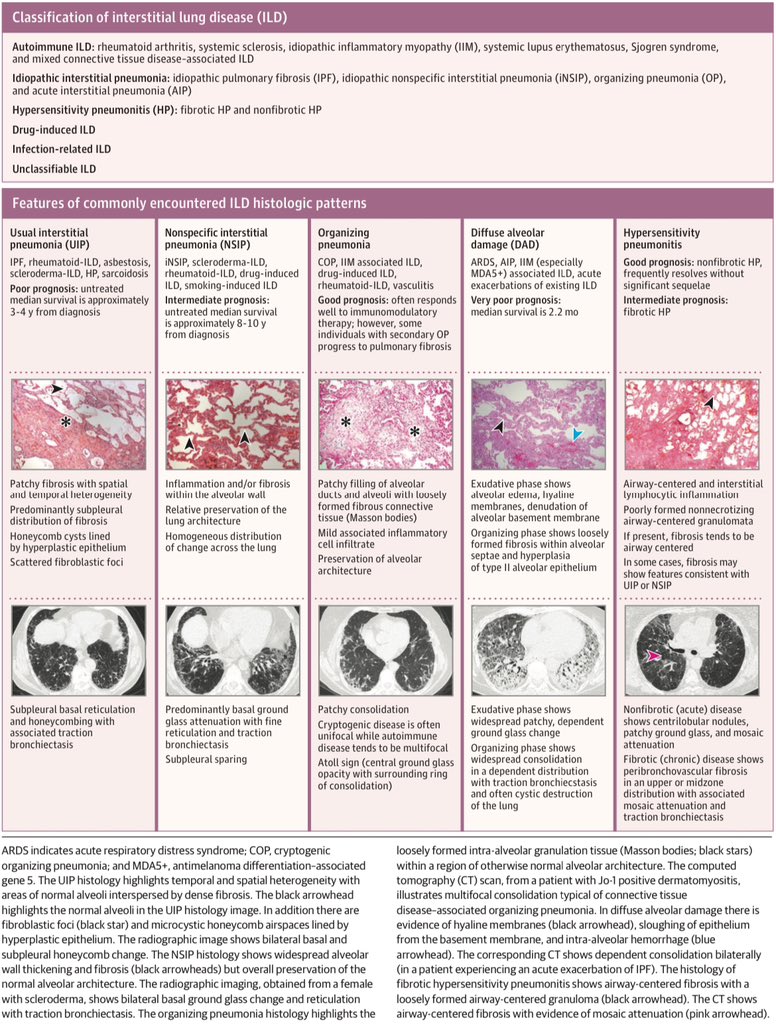 Clasificación y descripción de las enfermedades pulmonares intersticiales más frecuentes:

JAMA 2024; DOI: 10.1001/jama.2024.3669