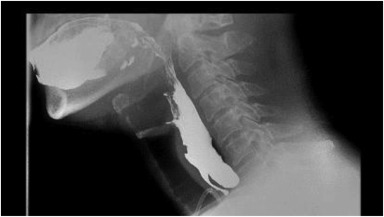Sanjay Palat et al apply 'Endoscopic management of recurrent Zenker diverticula after failed surgical repairs' in this Original Article. videogie.org/article/S2468-… @AhmadBazarbashi @KaraRaphael